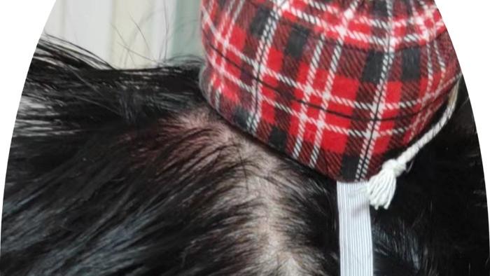 子宫脱垂艾灸调理