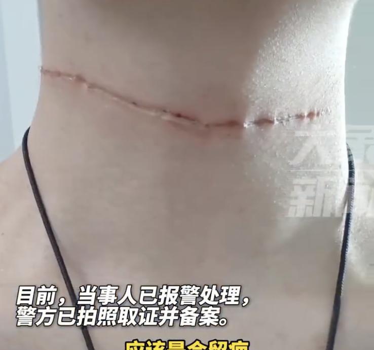 “注意了！2天发生3起同类案件”近日，河南一17岁男孩骑车，突然被风筝线割伤脖子
