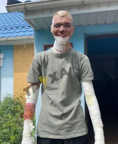 看到这名乌克兰士兵挺可怜的，身上受到了大量地创伤。很明显地是受到了外部地创击，他