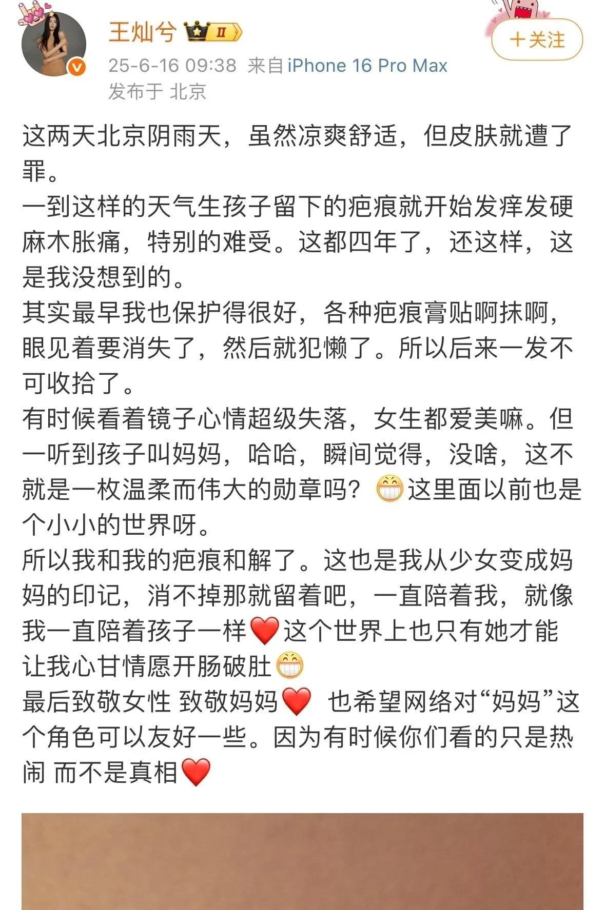#夏日生活打卡季#
王灿与疤痕和解，当妈专属“勋章”太戳心
愿每个妈妈都能和自己