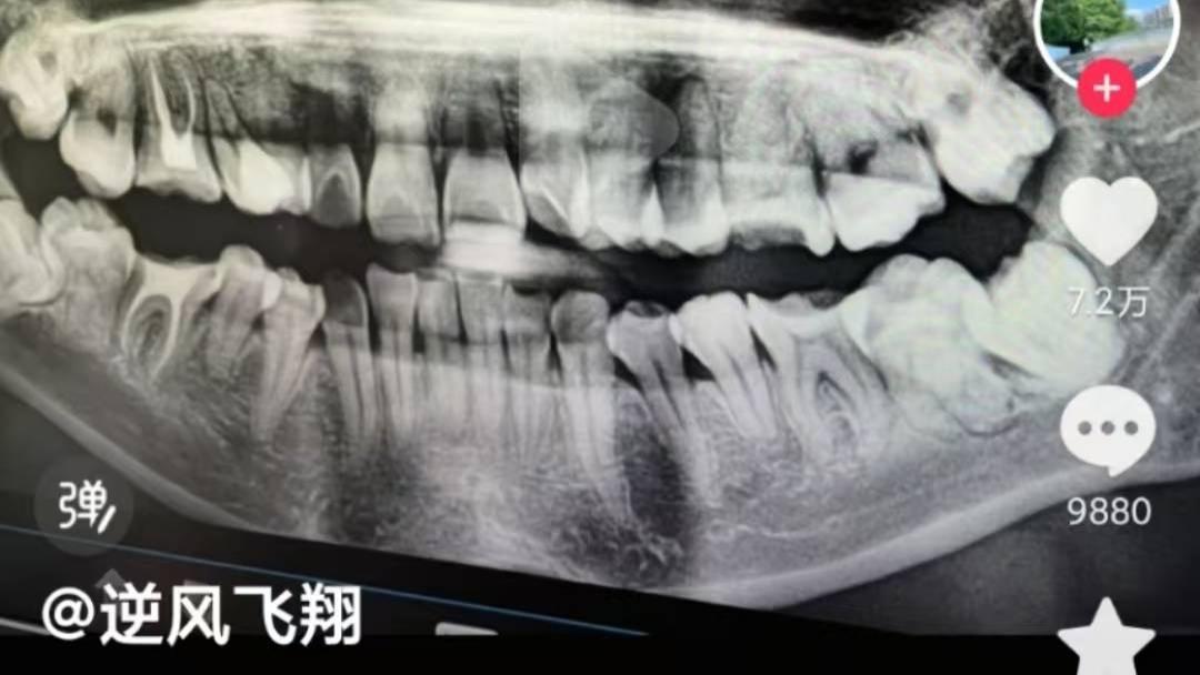 惊爆！女子拔错智齿后离奇坠亡：揭开三甲医院背后的医患生死局