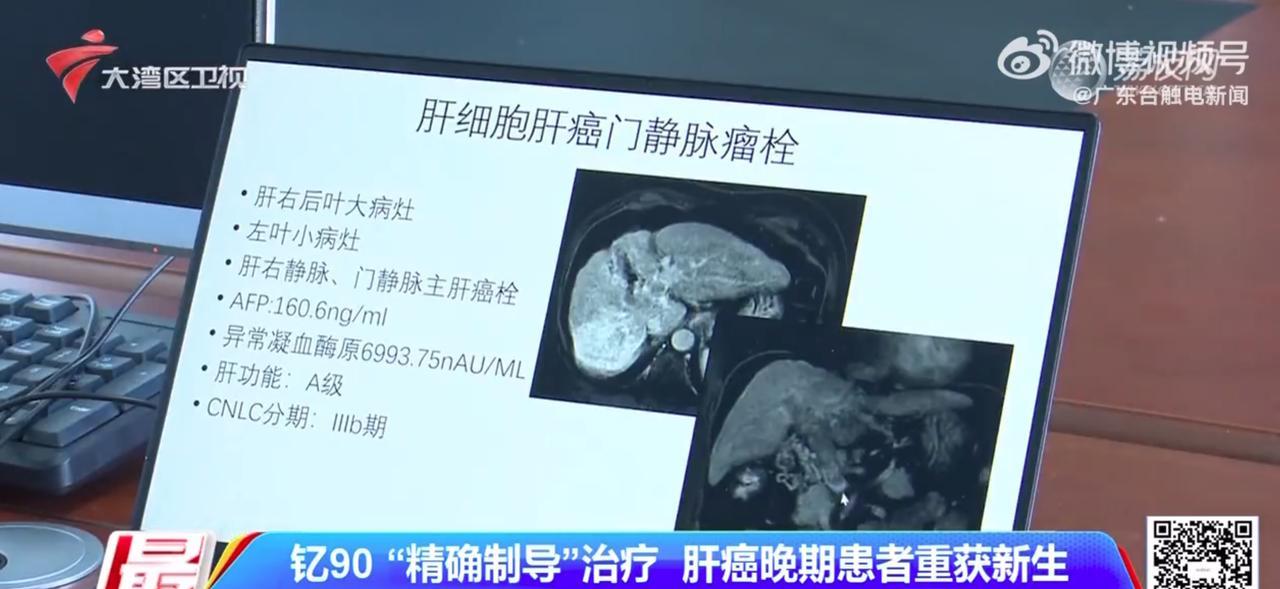 打一针就能治疗肝癌吗？2024年，陈先生被确诊为肝癌晚期，由于肝硬化严重且肿瘤位