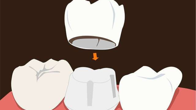 根管治疗后，为什么牙医坚持让你做牙冠？