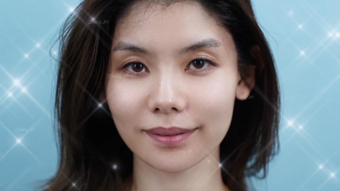 面部轮廓重塑效果如何？真人案例：玻尿酸打造高级建模脸！