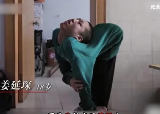 奇迹！山东德州，16岁的姜延琛脑袋长在屁股上，这位“折叠男孩”被医生宣判“死刑”