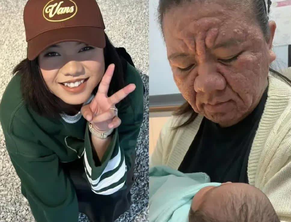 一位28岁的马来西亚女子怀孕8个月，面孔几乎变成了82岁的老太太模样，这也太恐怖