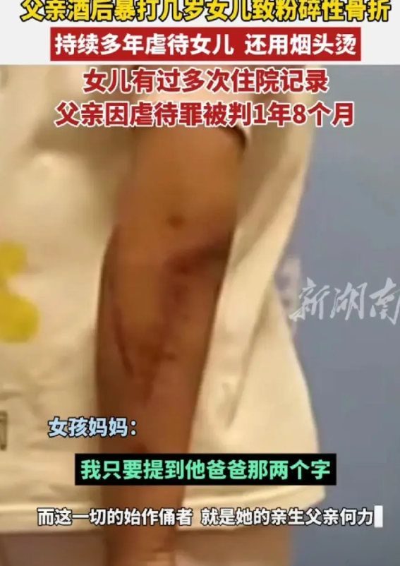 父亲酒后暴打6岁女儿导致粉碎性骨折，男子酒后虐待亲生女儿，用烟头烫用脚踹，用水管