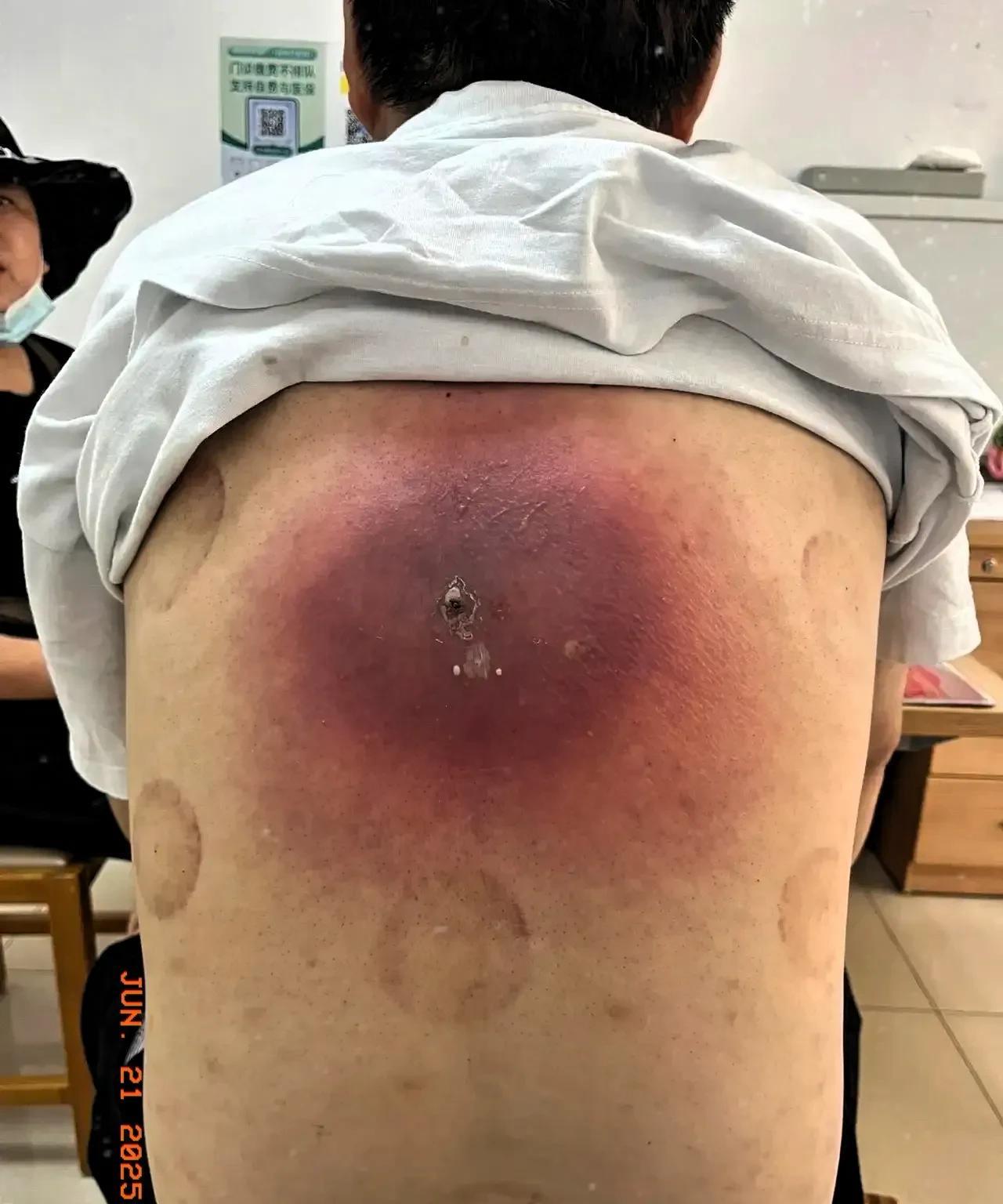 小伙子30几岁，近几日这段时间背上老长疖子。吃过一些中药，吃过一些西药，都不见好