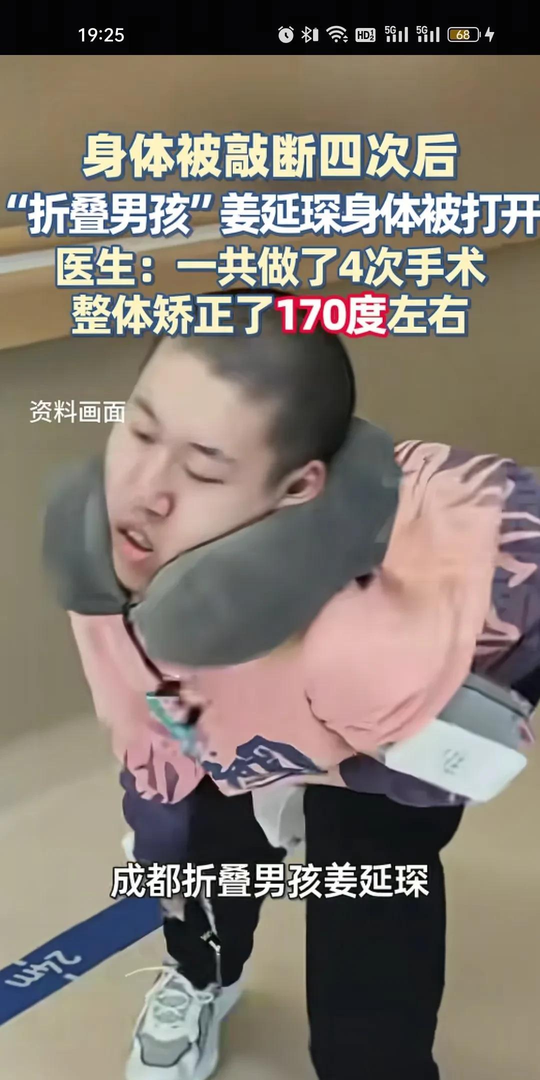 折叠男孩跪着考上大学，准备站起来考研，成都折叠男孩姜延琛做了4比次手术，整体矫正