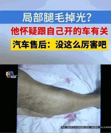 近日，浙江诸暨的赵先生意外发现，自己原本汗毛很密的大腿，近来却慢慢的秃了，怀疑与