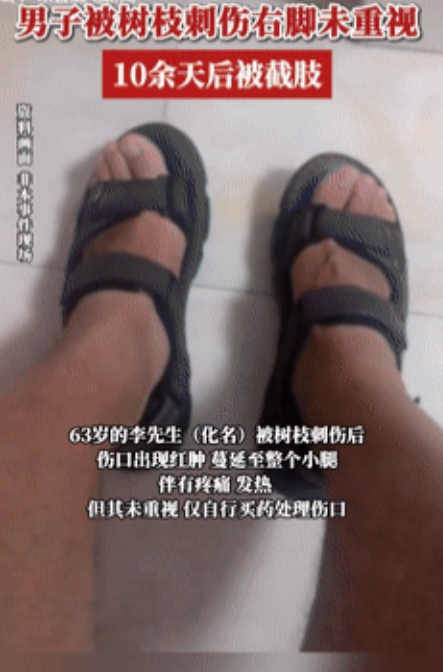 命有一劫！广东，一大爷散步被路上的树枝给刺伤了，只觉得脚上有点疼就没有在意，不料