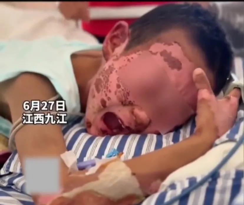 奶奶带两个孙子烧蚂蚁窝，引燃一桶10斤酒精，两个孙子被重度烧伤。
一个普通的病房