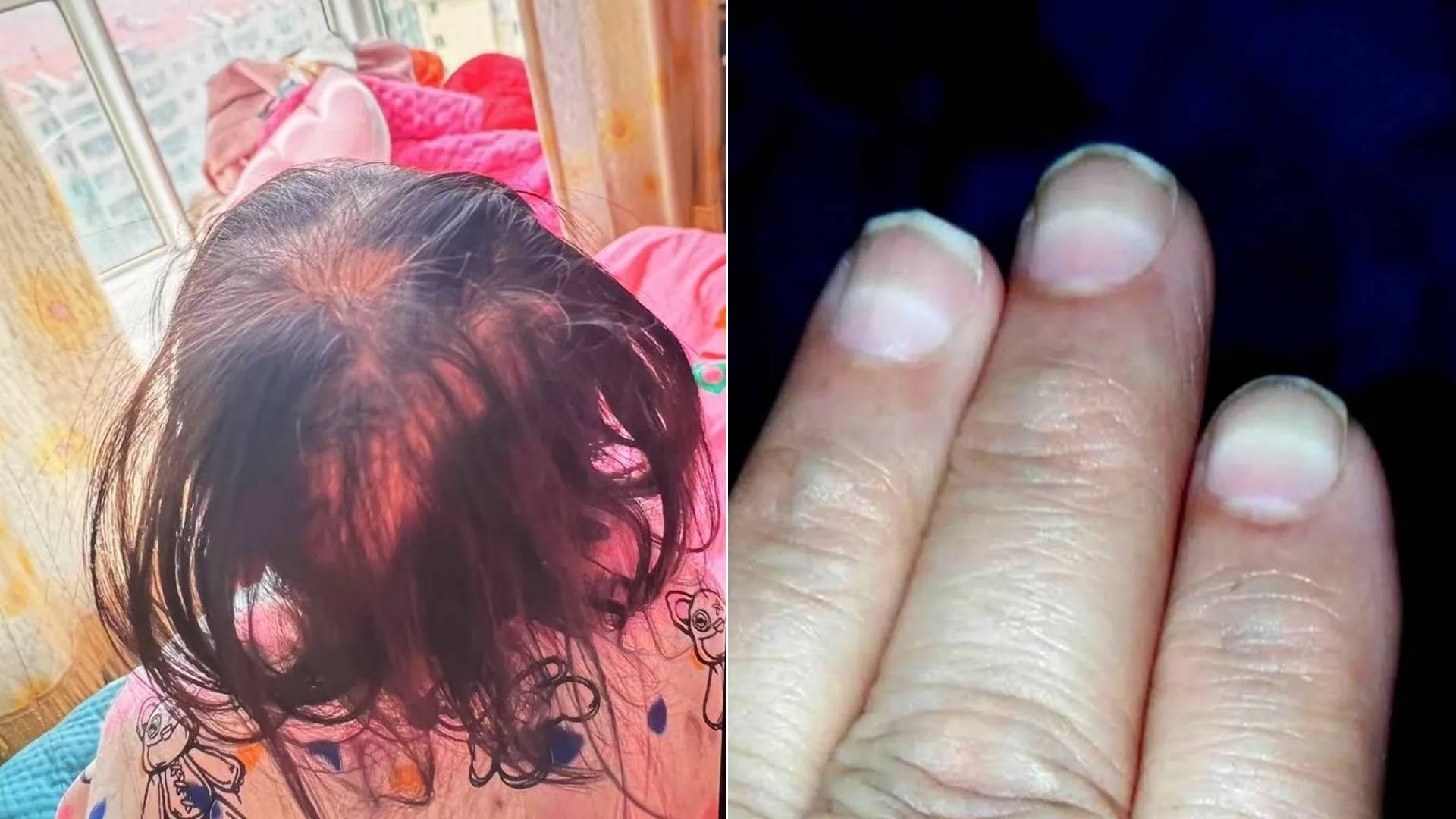 三岁女童离奇脱发，竟是有人往奶粉里掺了“隐形毒药”！你绝对想不到，凶手竟是朝夕相