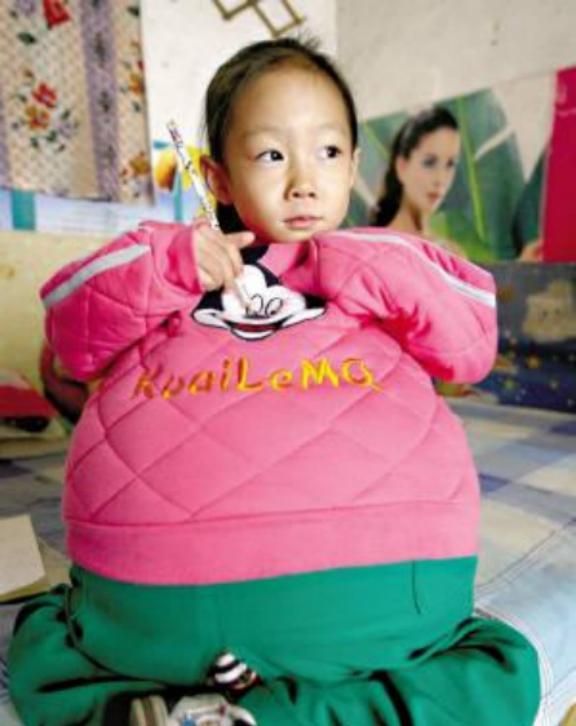 2010年，山西4岁小女孩胡云星，肚子像孕妇一样大，医生说她可能活不过三个月，一