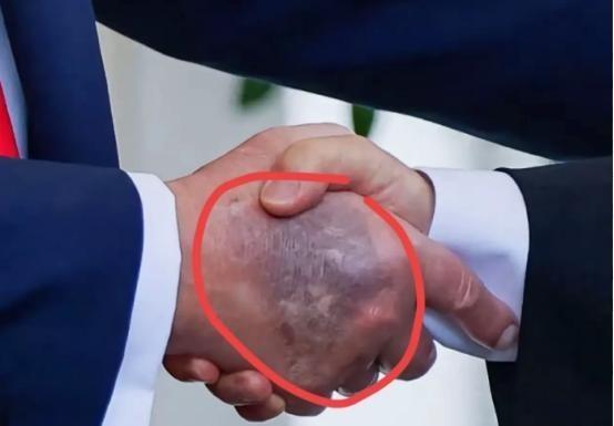 特朗普在白宫会见李在明，被记者拍到手背乌黑淤青，最初面积小时还涂遮瑕膏，现在面积