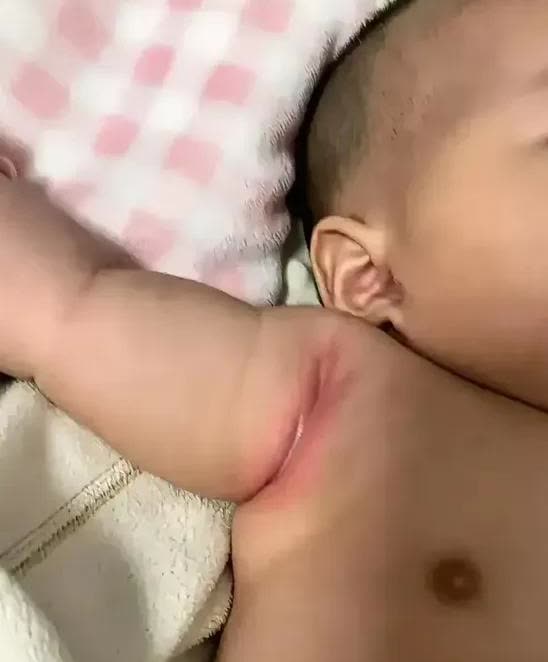 广东，一名女子给孩子换衣服的时候，突然发现他的脖子、腋下的皮肤又红又肿。她感到很