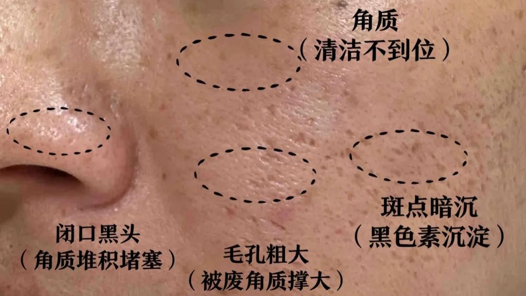 生理盐水真的对毛孔粗大有用吗？