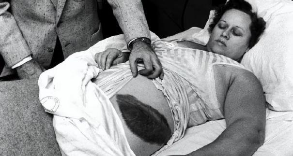 1954年，国外一女子正在睡觉中，突然感觉腹部和大腿被什么东西蹭着了一样，疼痛难