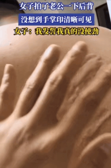 6月7日，安徽一妻子在家跟丈夫开玩笑，朝丈夫后背来了一巴掌，结果，丈夫后背竟然出