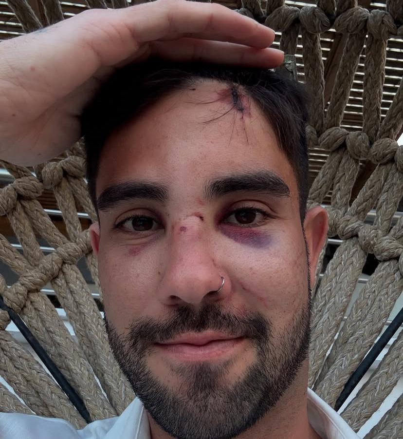 据了解，这位爱尔兰网红当时只是在希腊的街头正常地活动，却无端遭受这样的暴行。他的