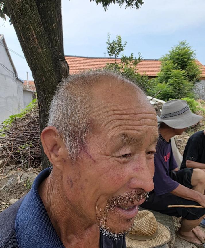 78岁老人上山打羊草，脸上被槐树枝划出一道又深又长的口子，他自己用手捏捏，把裂开