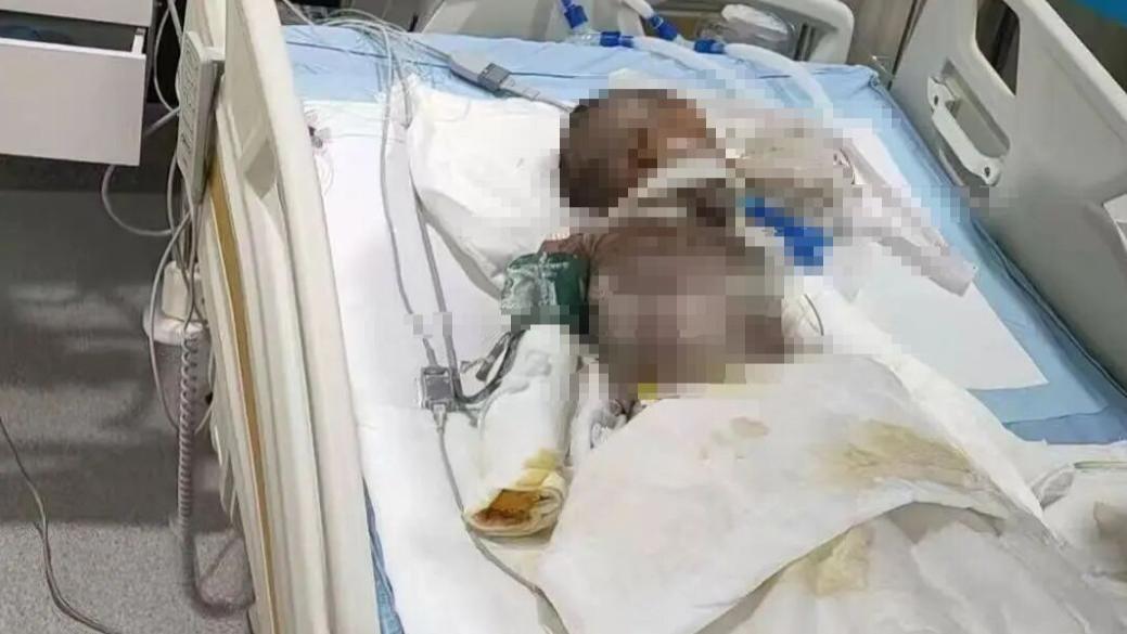 3岁男孩跌入炭堆，85%烧伤命悬一线！45万善款能否带来生机？