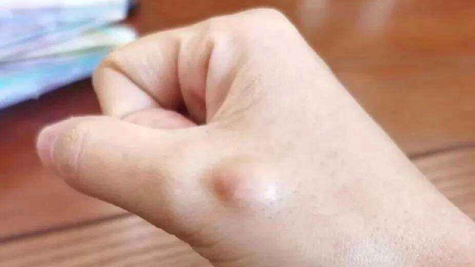 脂肪瘤患者有3个变化，说明病情正在好转