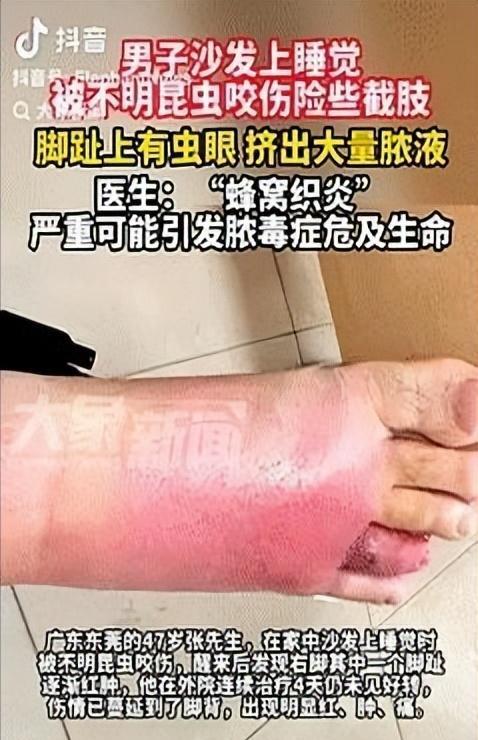 “不幸中的万幸！”近日，广东东莞，一47岁男子在沙发上睡觉时，被不明昆虫咬伤，醒