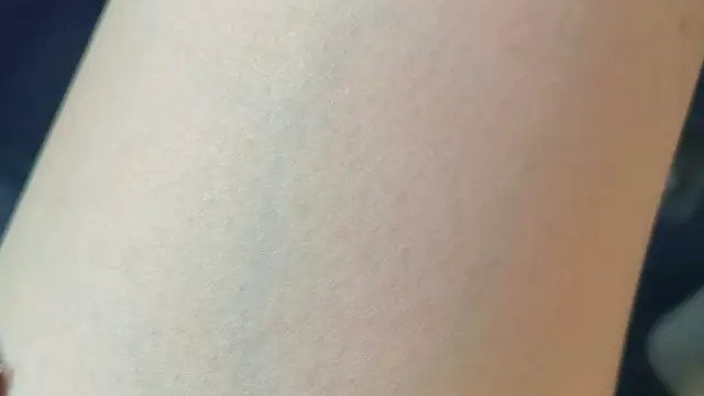 静脉明显≠静脉曲张，3个步骤教你初步辨别“青筋凸起”是正常还是疾病！
