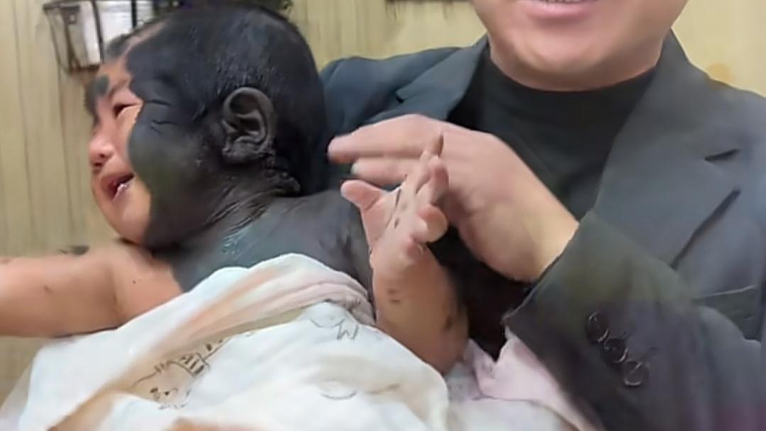 河南男孩身上长满兽皮痣 宛如杨志手术还需几十次