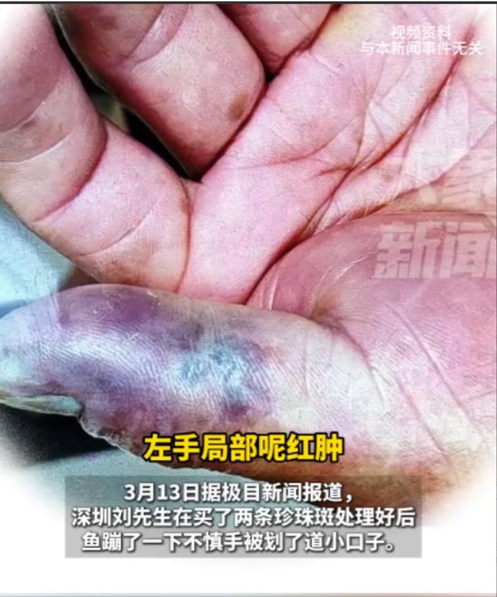 广东深圳，一男子在家里处理鱼的时候，不小心被划出道小口子，当时并没在意，结果晚上