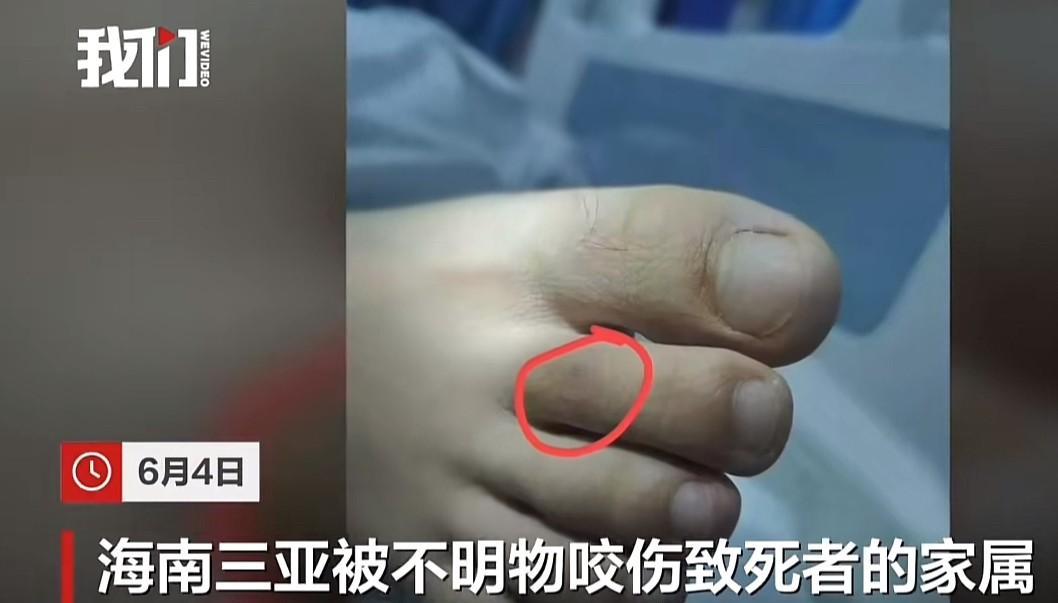 讲真哦
真不能怪这位被蛇咬的女子没当回事！
看曝光的被咬脚趾头照片，确实没红没肿