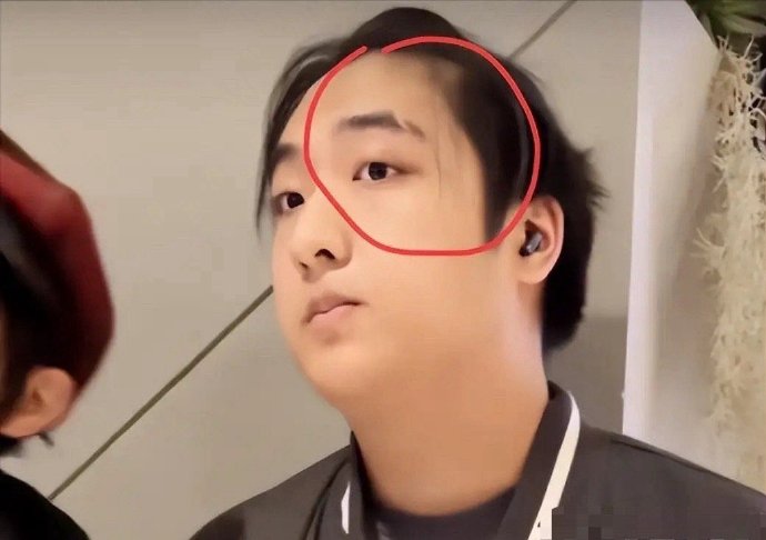 费曼眉梢那有道明显的伤疤，现在才知道当年吴镇宇在节目里怒摔话筒是有原因的
