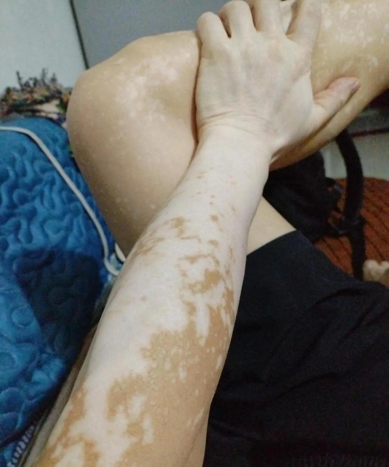 虽然相对别的一些病症来说，它不痛不痒不影响日常生活，但是在求学、工作、相亲等众多