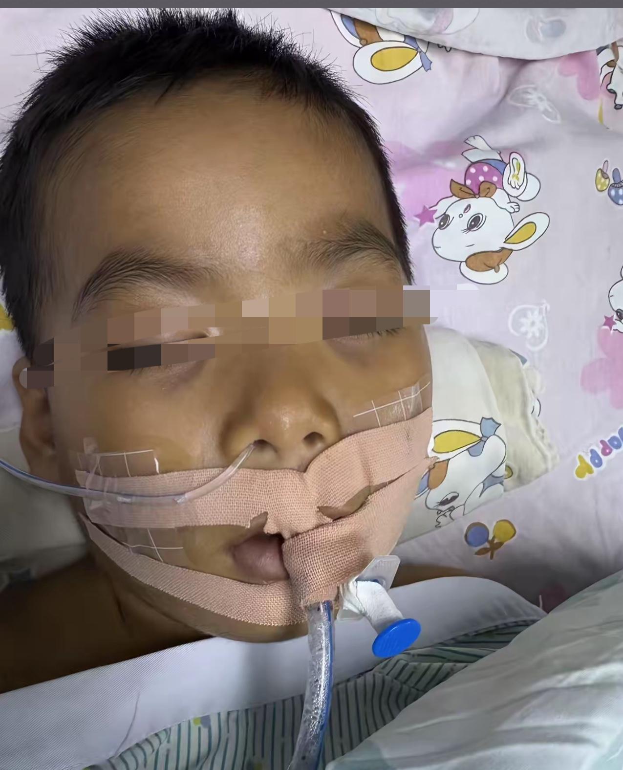 3岁小男孩切除扁桃体脑死亡！瞧，他脸色发黑，眼皮垂着，瞳孔涣散 ，那么小而可怜，