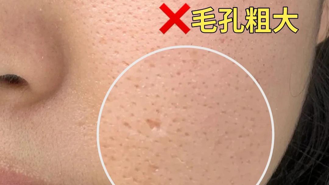 下巴爆痘反反复复