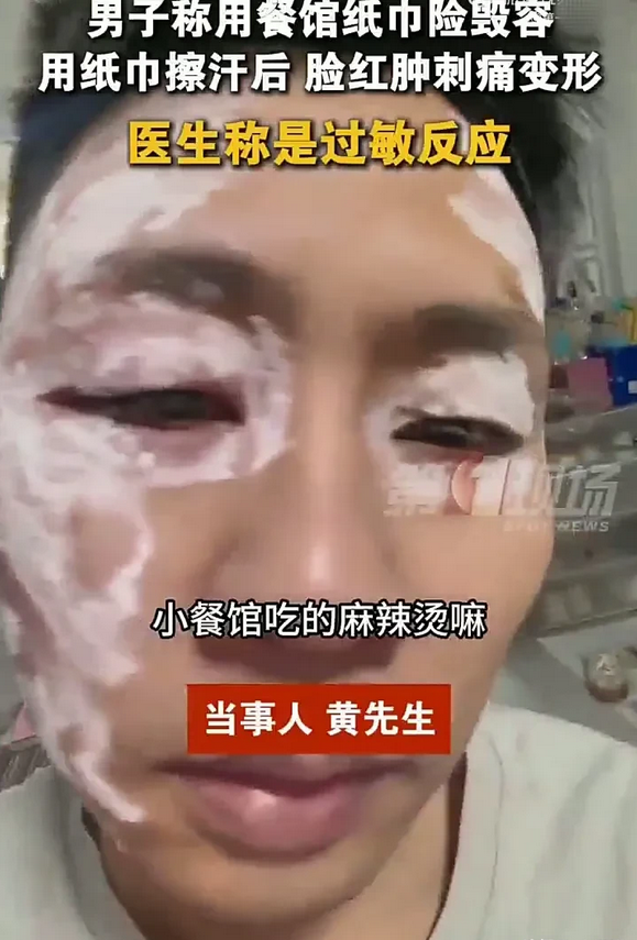 安徽男子用餐馆纸巾后脸部严重过敏