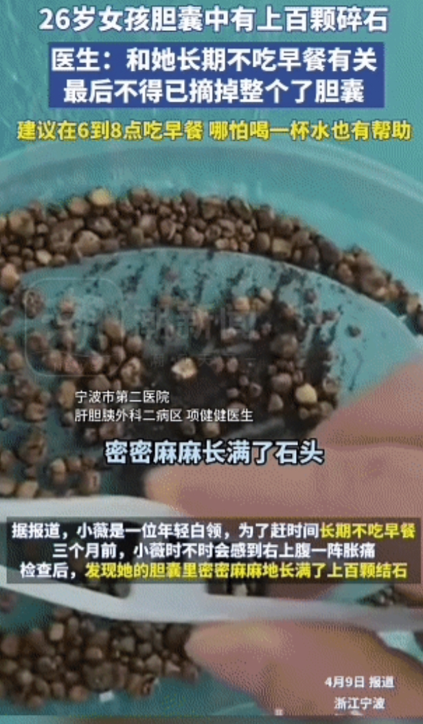 “太恐怖了”！浙江，宁波的小薇，才26岁，胆囊里竟然塞满了石头，医生当场都看傻了