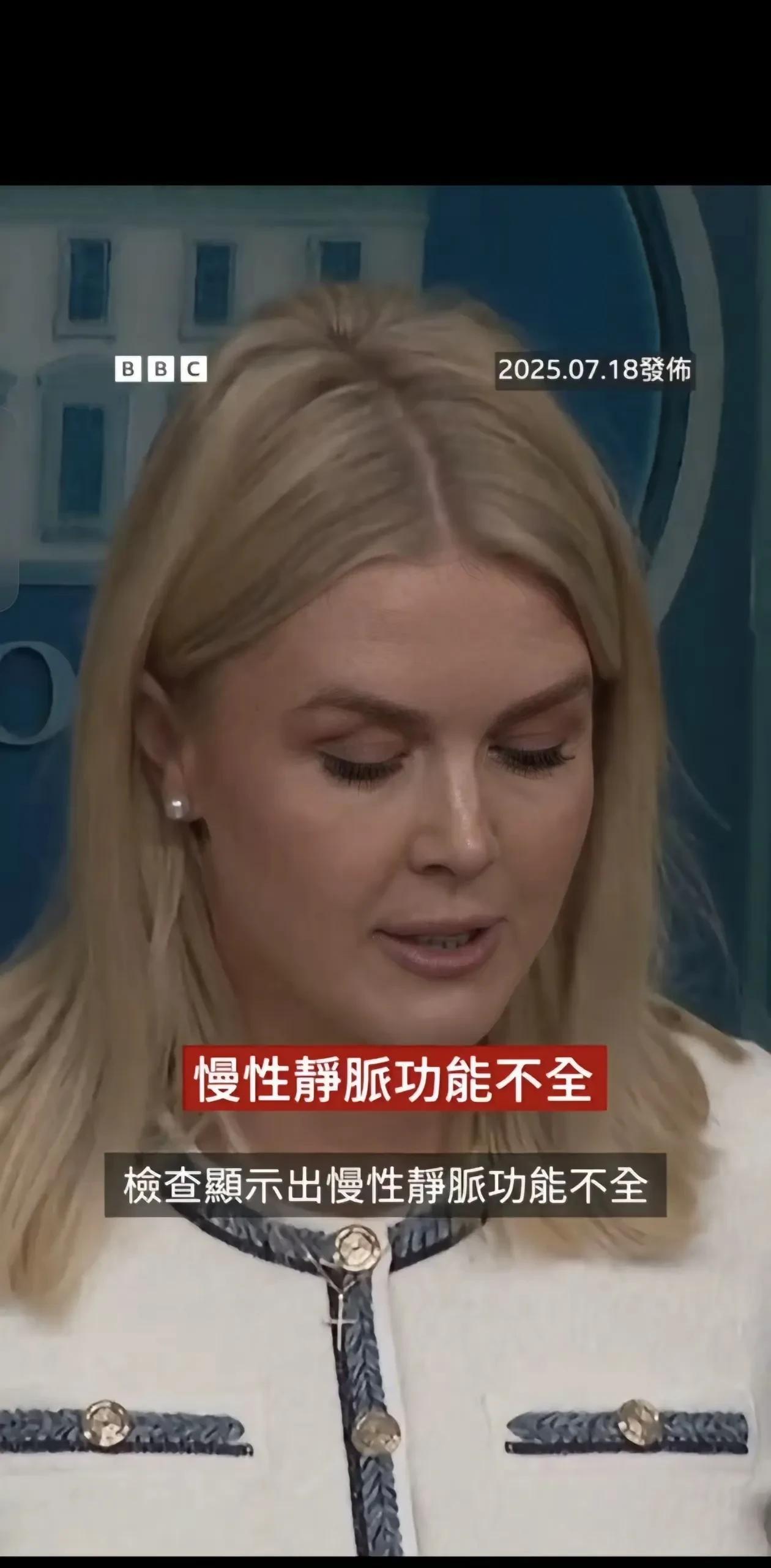 川普确实老了，图2-3是他的手。
医生诊断结果就是说是他握手握多了，导致静脉曲张