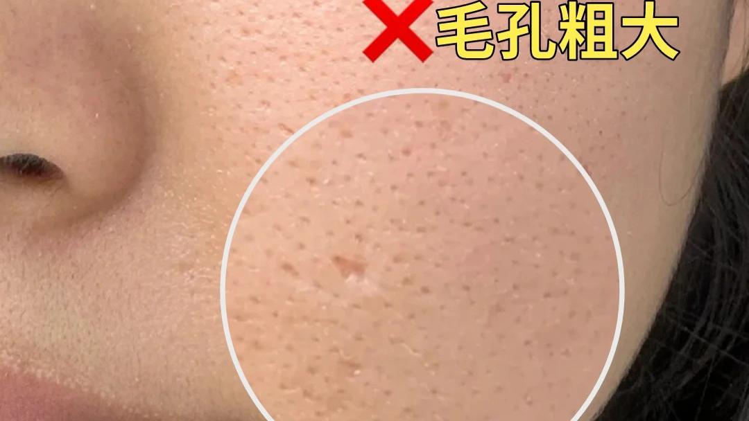 痘印痘坑毛孔粗大怎么改善？