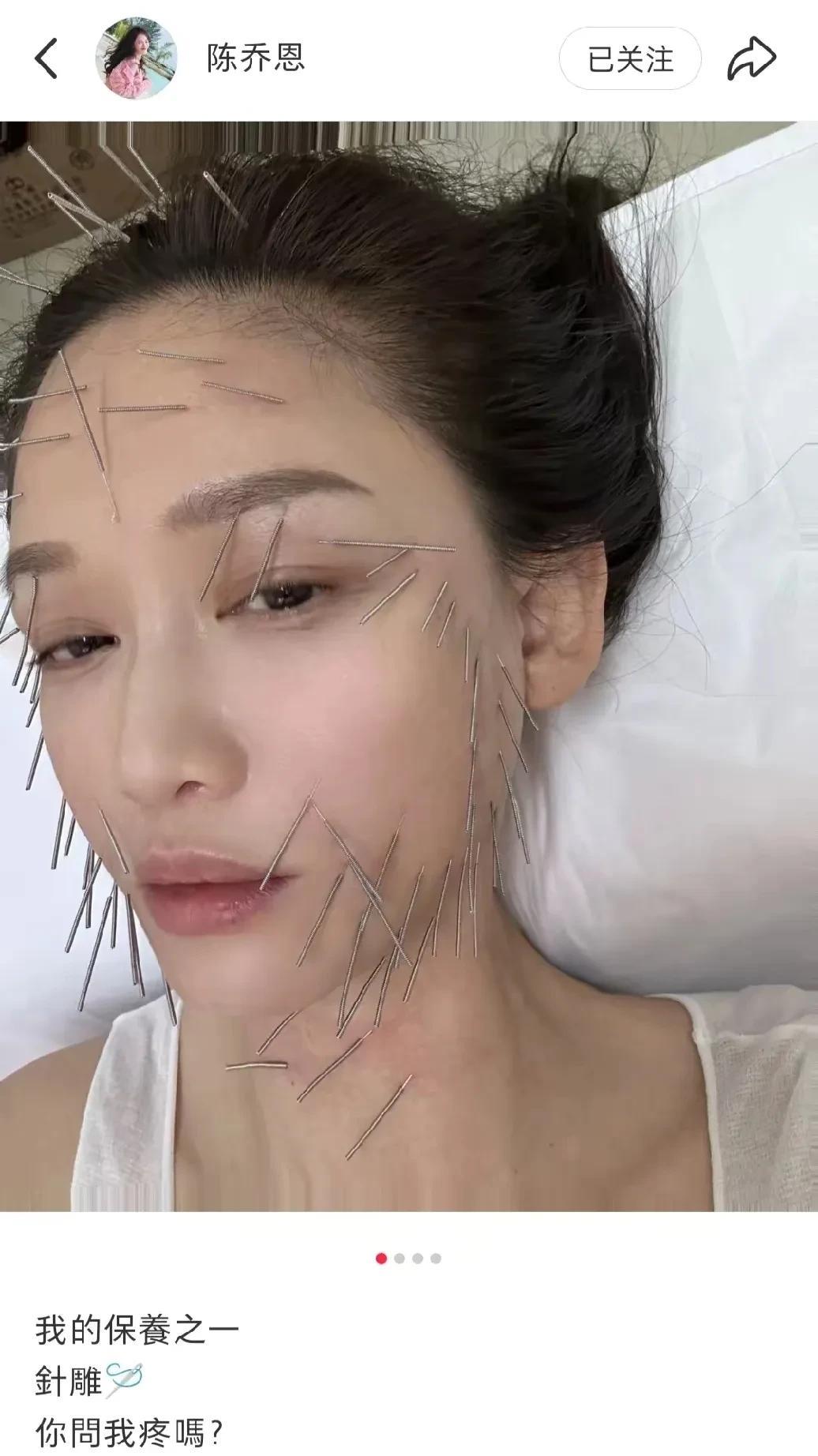 我的妈呀，这也太吓人了吧。
看看陈乔恩，为了美，付出的代价，都快被扎成刺猬了。