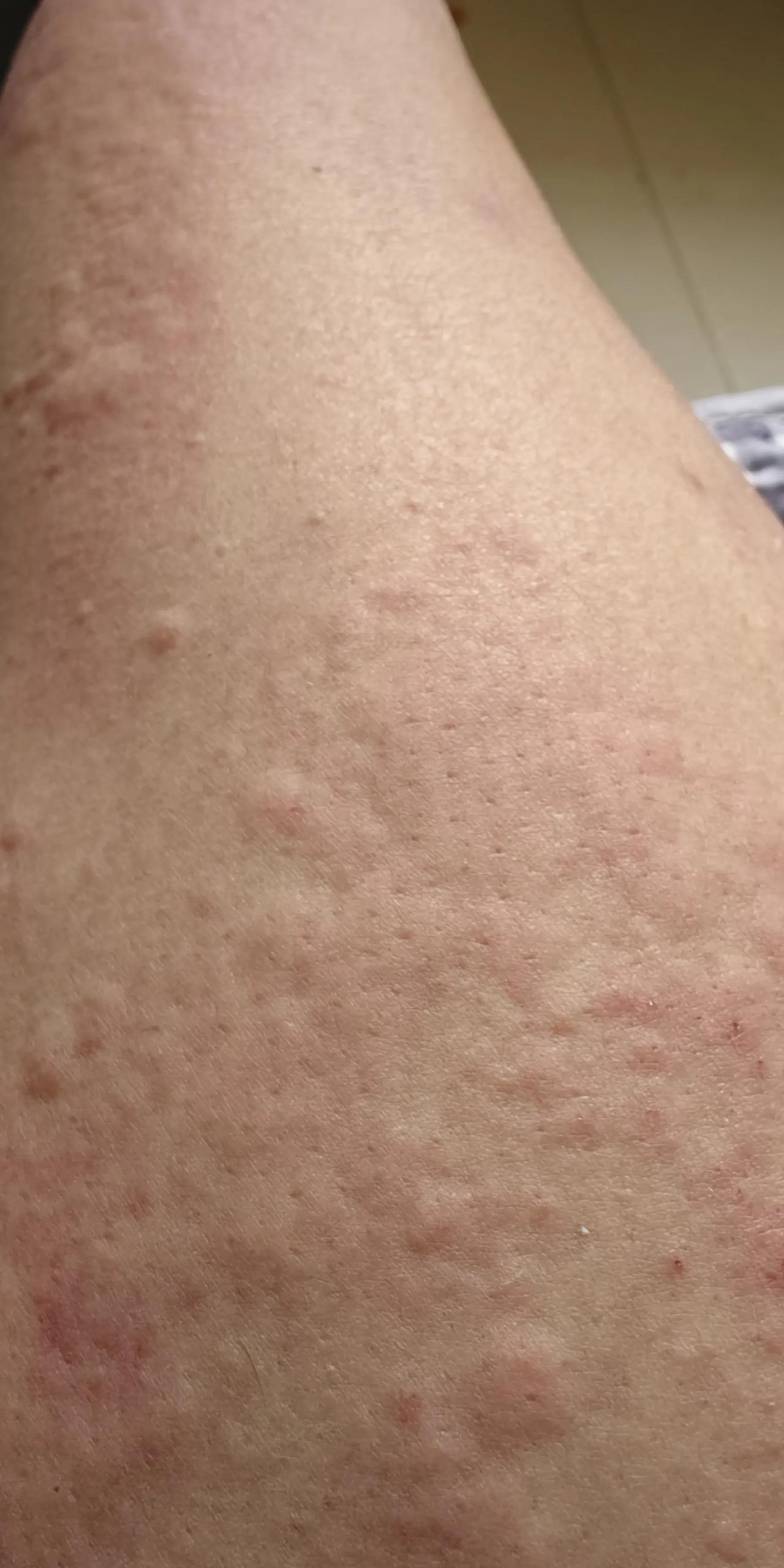 紧急救助，这到底怎么回事儿，昨晚到现在从头到脚浑身都是痒的。只要挠一下就会出现个