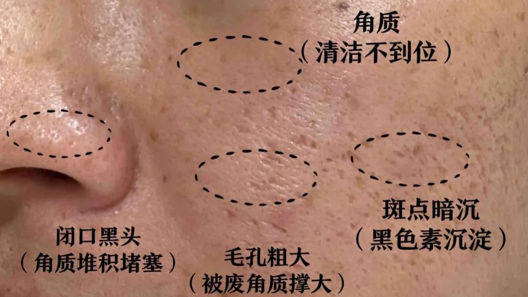 毛孔粗大真的没办法改善了吗？