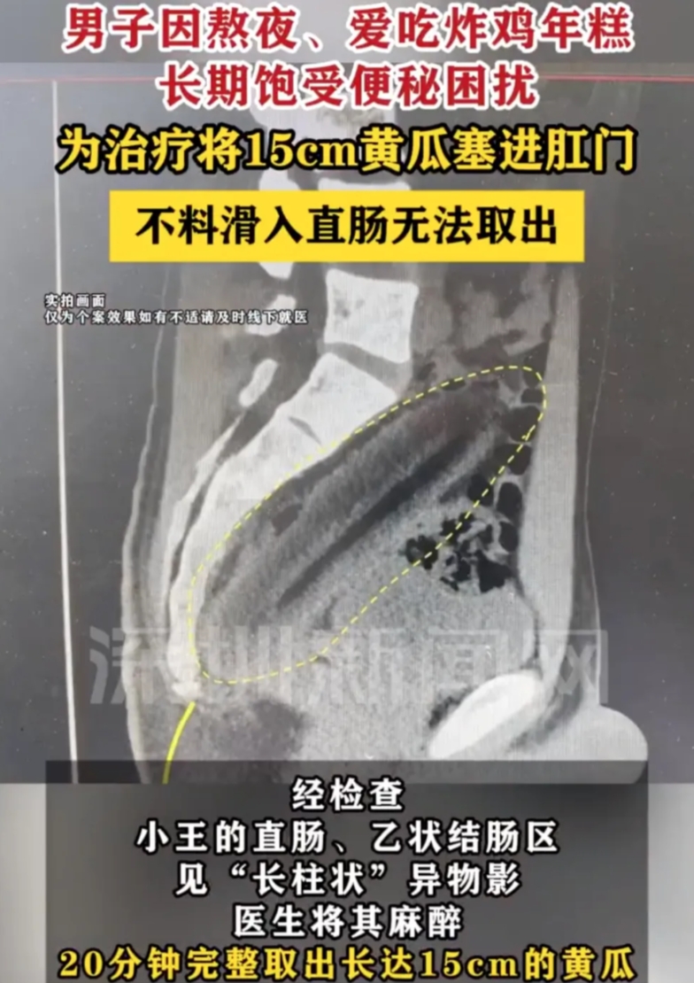 “离了个大谱！”3月27日，江苏扬州，一男子饱受便秘的困扰，情急之下，男子竟然将