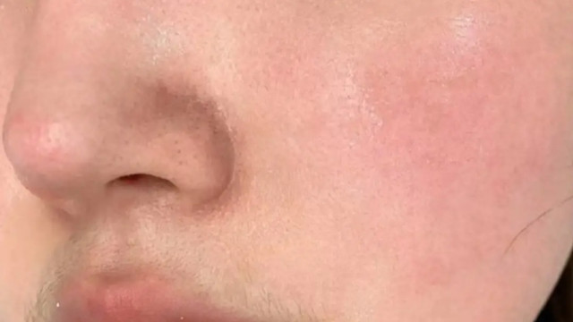 干皮敏感肌毛孔粗大怎么办？三步温和护理法实测有效