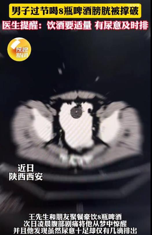 陕西一男子和朋友喝酒，连喝8瓶都没上厕所，回到家发现明明想撒尿却尿不出来了，去医