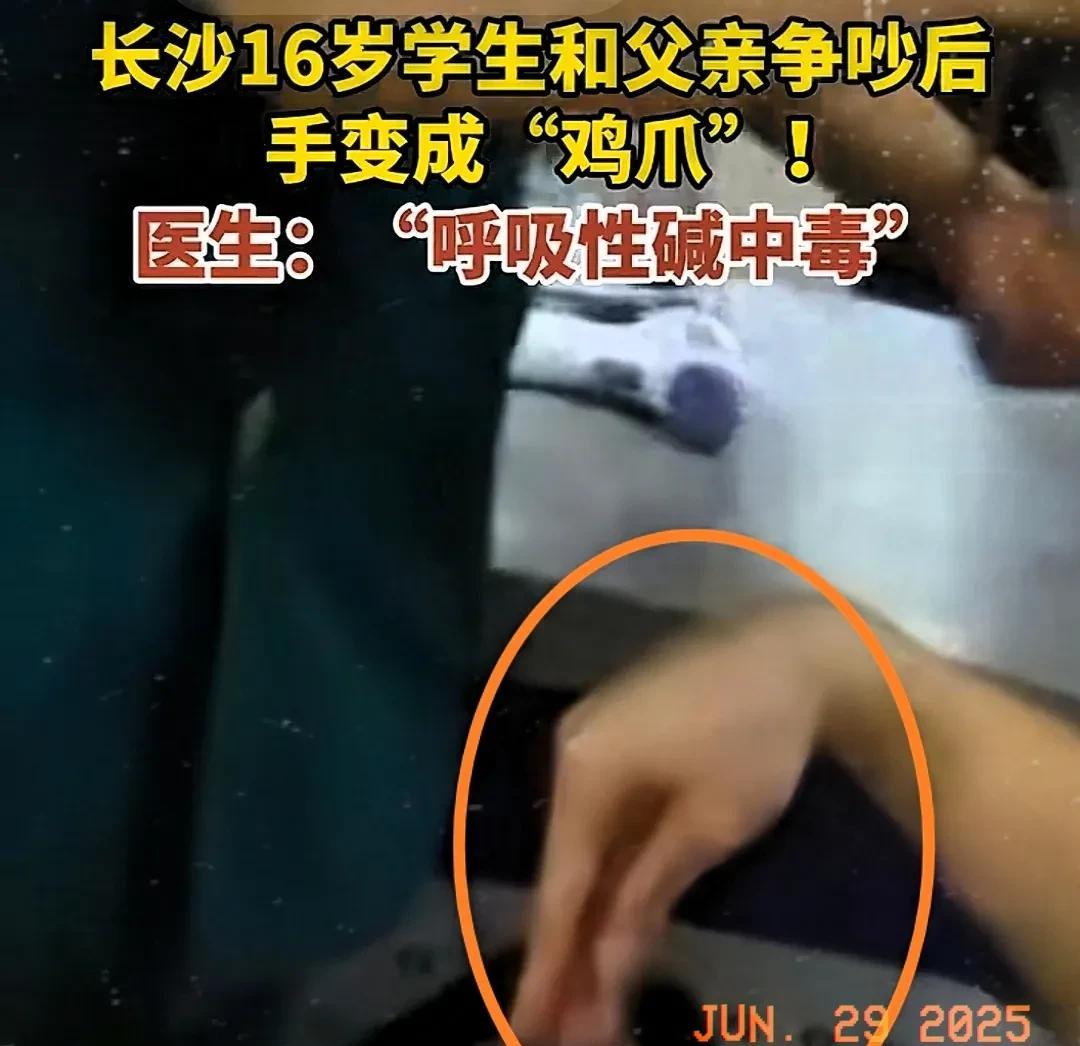 近日，刷到有个16岁的学生和他老爸发生了争执，结果把自己的手都气成“鸡爪”样，又