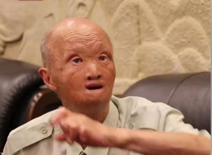 【志愿军老兵涂伯毅：被美机投掷汽油弹严重烧伤，上街曾吓哭孩子】志愿军老战士涂伯毅