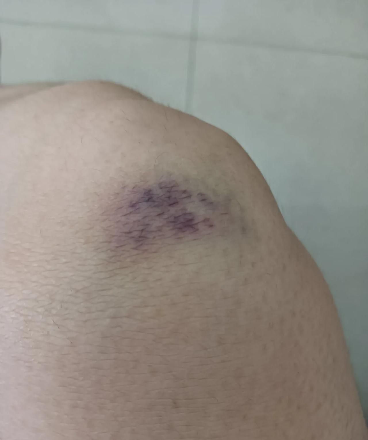 昨天晚上父子俩又干仗了！我因为护子心切也受了伤！
昨天晚上孩子爸回来，儿子砸在地