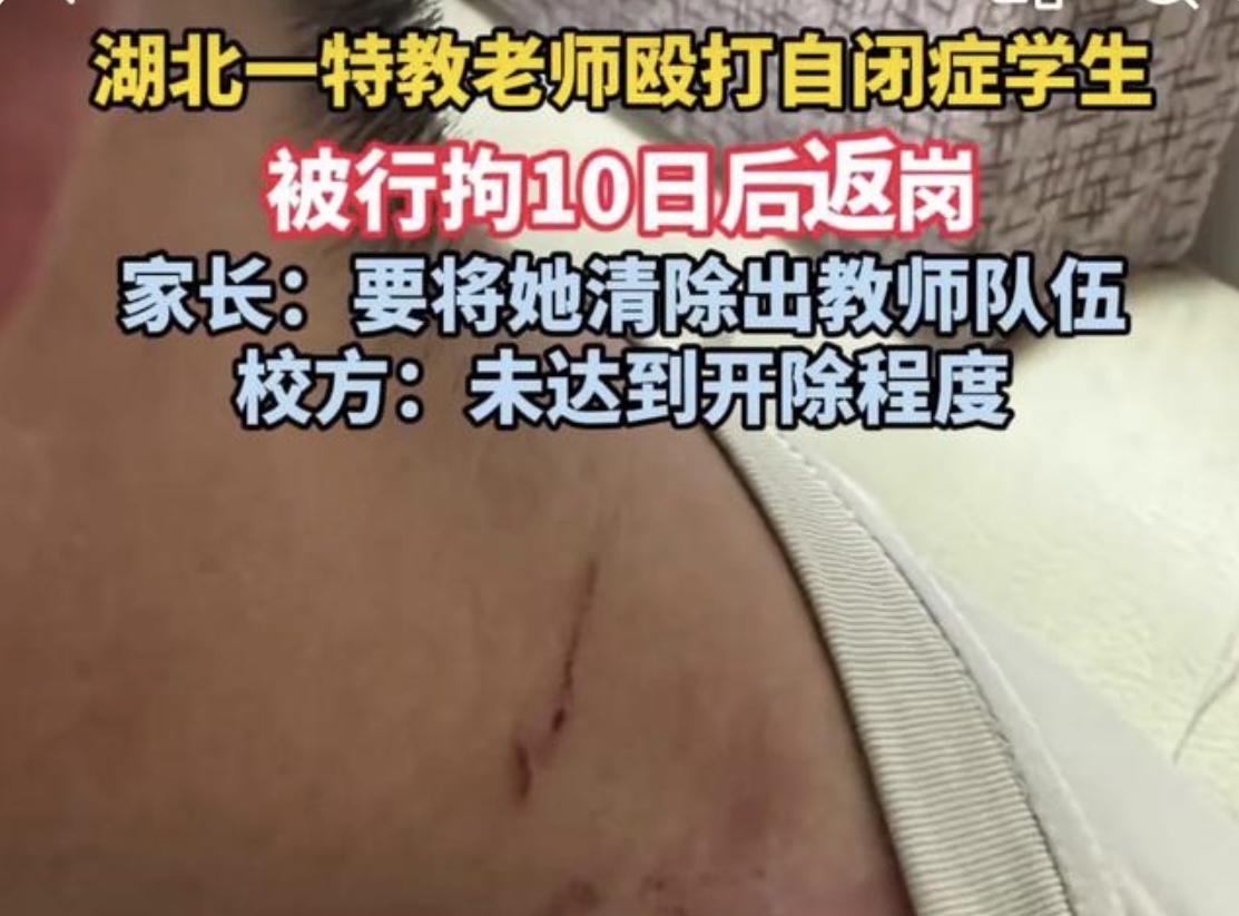 湖北恩施，特教老师被17岁自闭症男学生抓住头发后，情急反击被拘10日，出来后学生